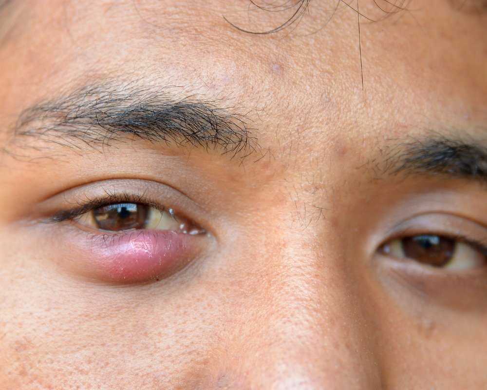 Autocuidados para Terçol: 5 Passos para Aliviar a Irritação