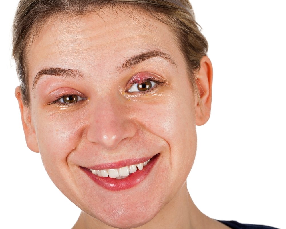 Autocuidados para Terçol: 5 Passos para Aliviar a Irritação autocuidados para tercol 02