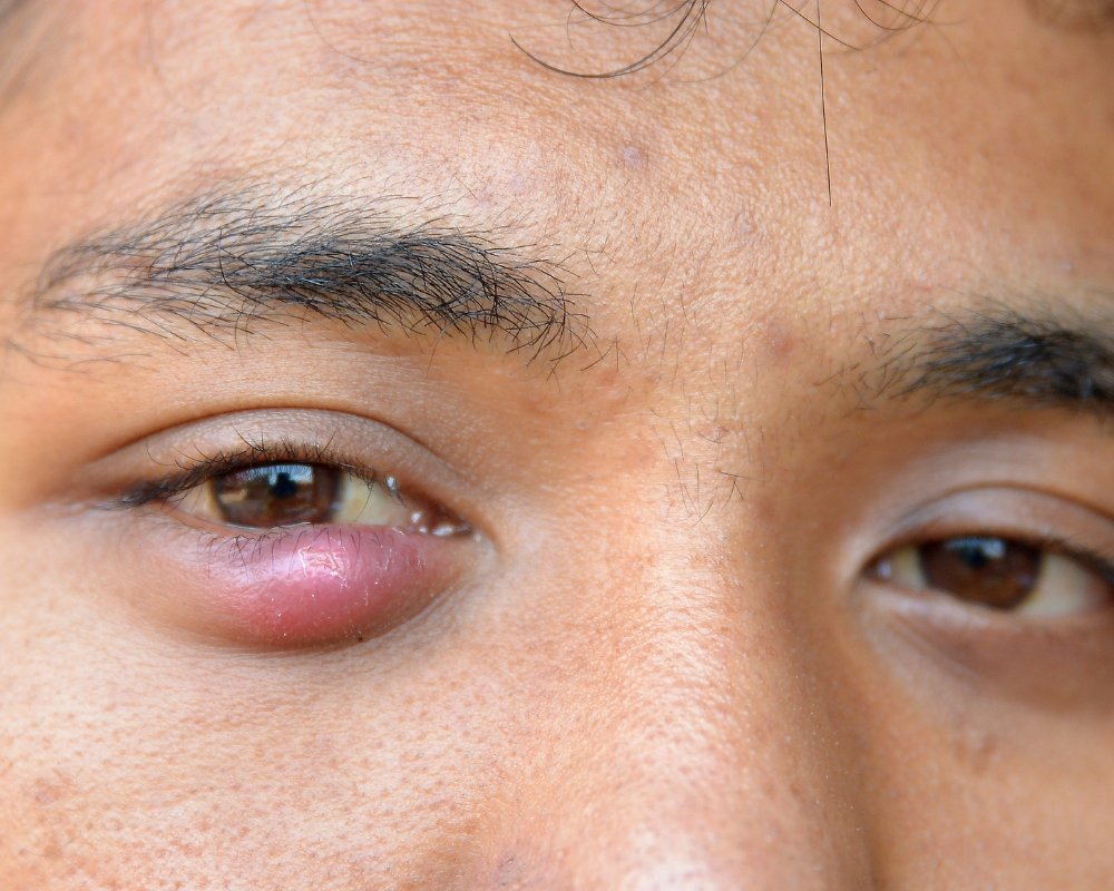 autocuidados para tercol